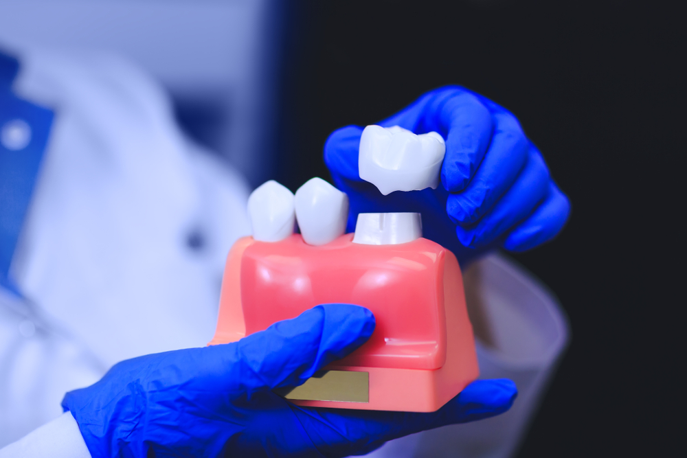 dental crowns