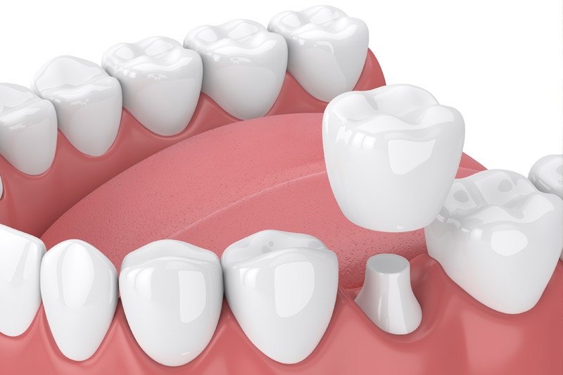 Dental Crowns in Plymouth