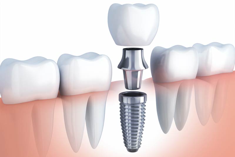 Implants Dentist in Plymouth